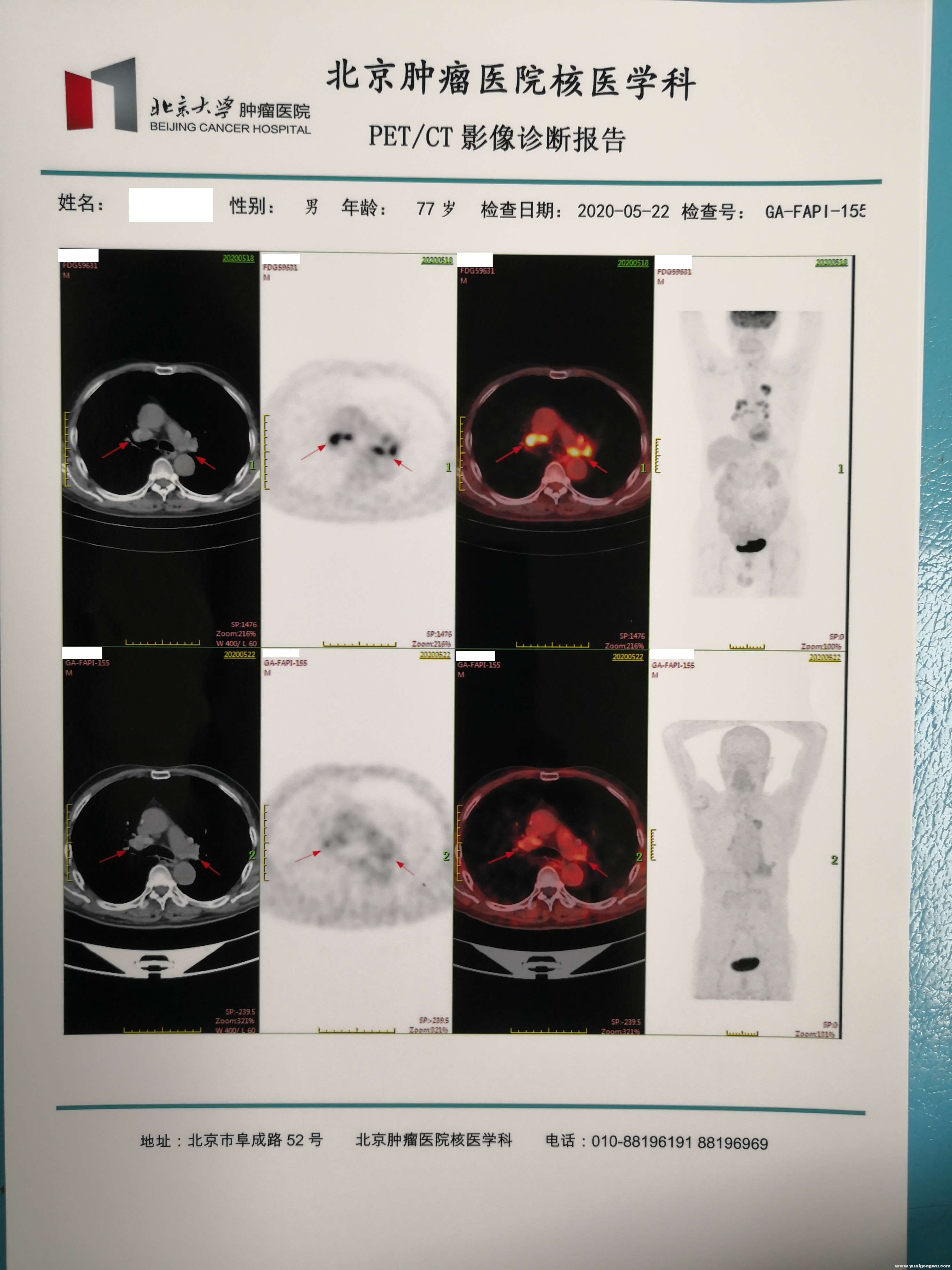 FDG和FAPI的对照2